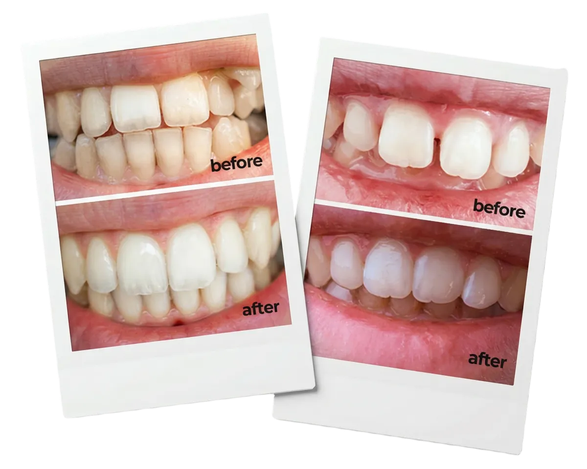 Before and after orthodontic treatment